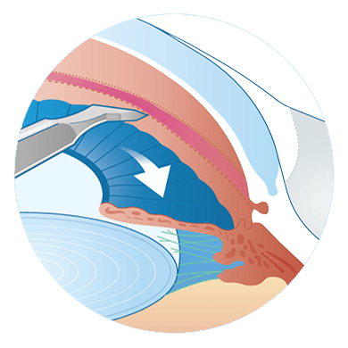 Goniotomy procedure illustration