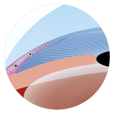 Implantable Stents procedure illustration